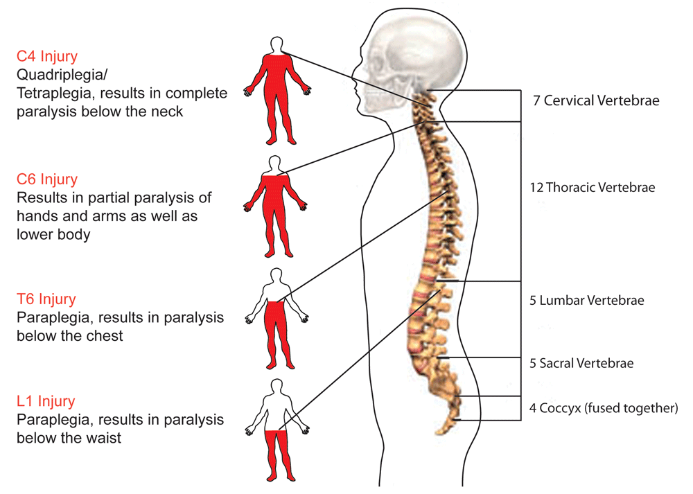 Spinal Cord Injury Image